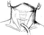 喉疤痕性狭窄的整复术图片