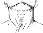 半喉切除术图片