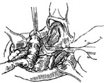 气管代喉术图片