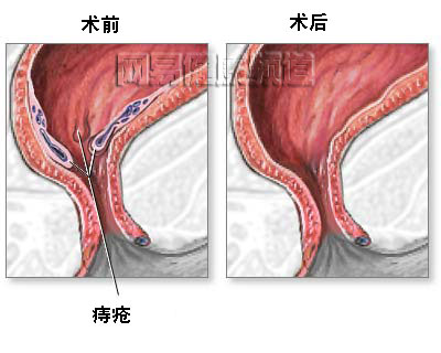 痔疮治疗术图片