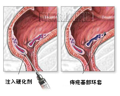 痔疮治疗术图片