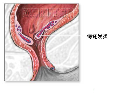 痔疮治疗术图片