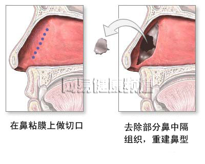 鼻中隔成形术图片