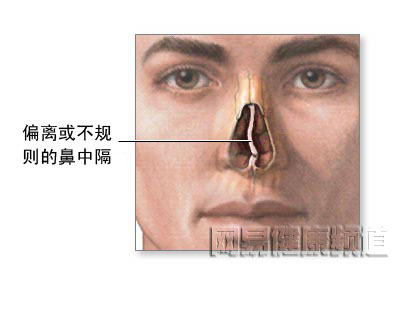 鼻中隔成形术图片