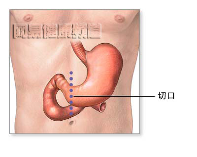胃切除术图片