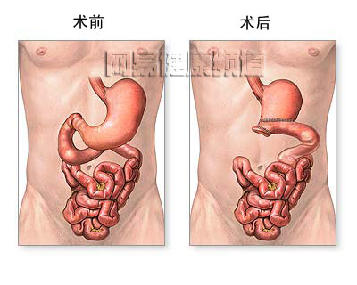 胃切除术图片
