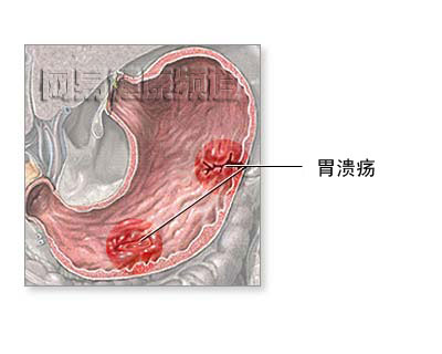 胃切除术图片