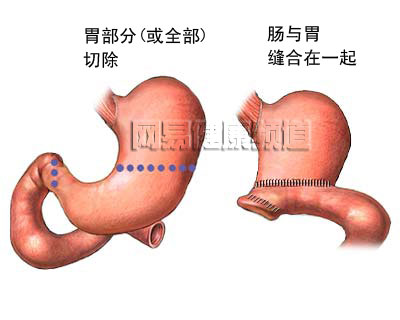 胃切除术图片