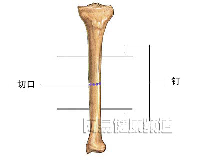 腿延长术图片