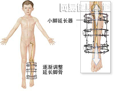 腿延长术图片