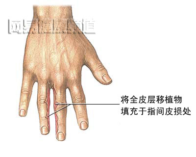 蹼指修复术图片