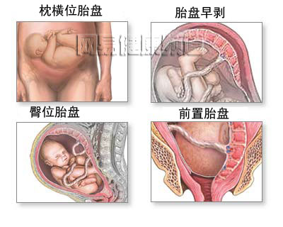 剖腹产手术图片