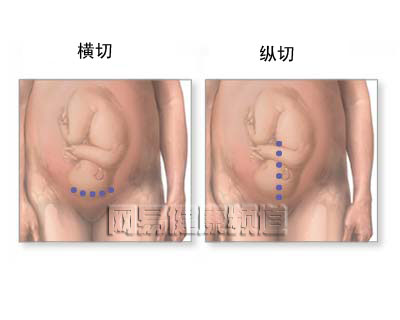 剖腹产手术图片