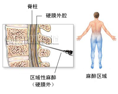 剖腹产手术图片