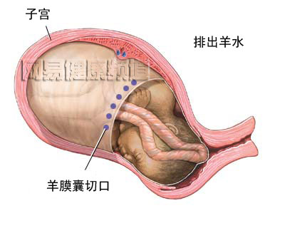 剖腹产手术图片