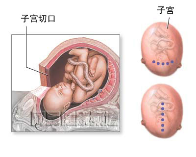 剖腹产手术图片