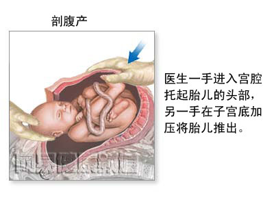 剖腹产手术图片