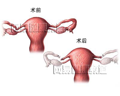 输卵管结扎术图片