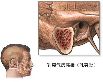 乳突切除术图片