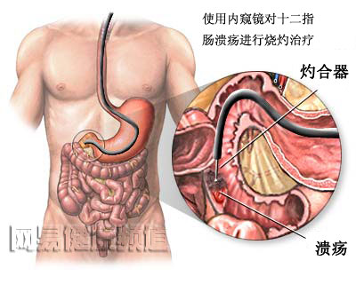 消化道出血治疗图片