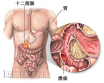 消化道出血治疗图片