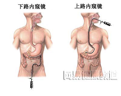 消化道出血治疗图片