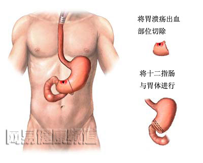 消化道出血治疗图片