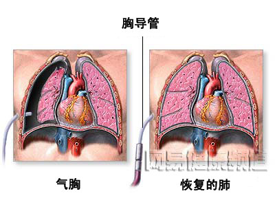 气胸治疗术图片