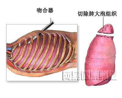 气胸治疗术图片