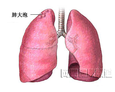 气胸治疗术图片