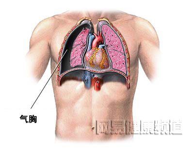 气胸治疗术图片