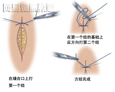 创口缝合术图片