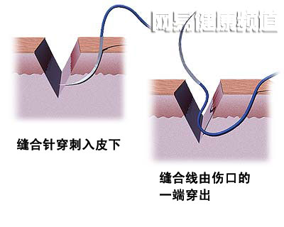 创口缝合术图片