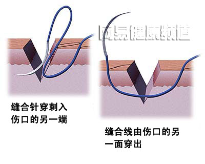 创口缝合术图片