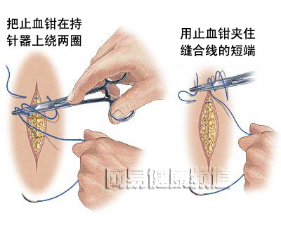 创口缝合术图片