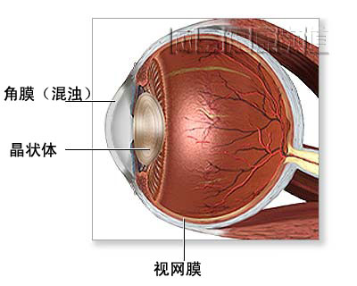 角膜移植术图片