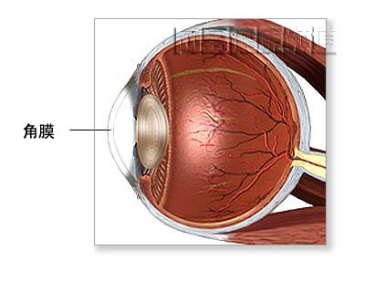 角膜移植术图片
