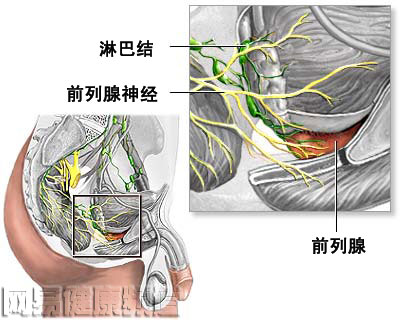 前列腺切除术图片