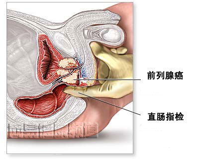 前列腺切除术图片