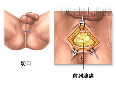 前列腺切除术图片