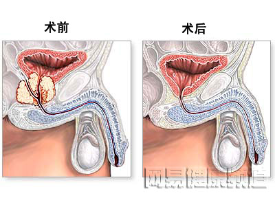 前列腺切除术图片