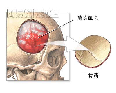 颅骨切开术图片