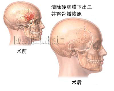 颅骨切开术图片