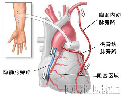 心脏搭桥手术图片
