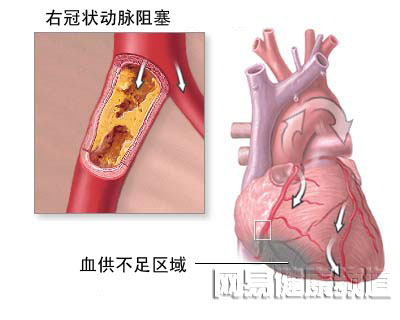 心脏搭桥手术图片