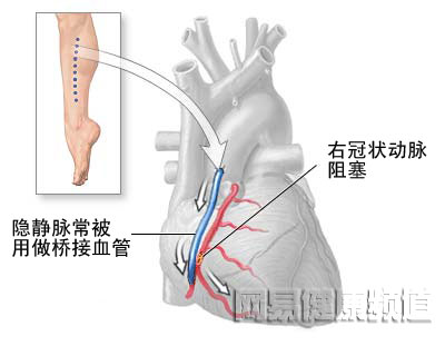 心脏搭桥手术图片