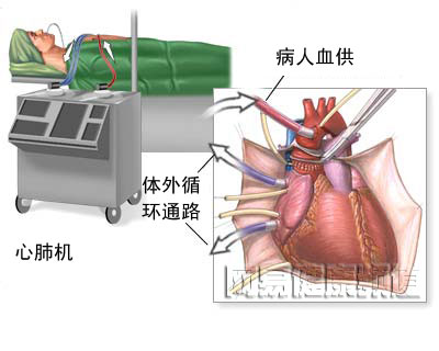 心脏搭桥手术图片