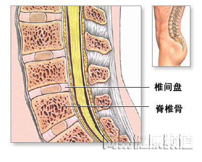 椎间盘突出骨移植修补术图片