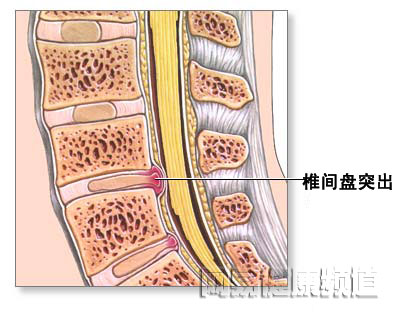 椎间盘突出骨移植修补术图片