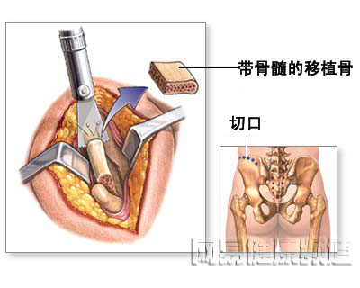 椎间盘突出骨移植修补术图片